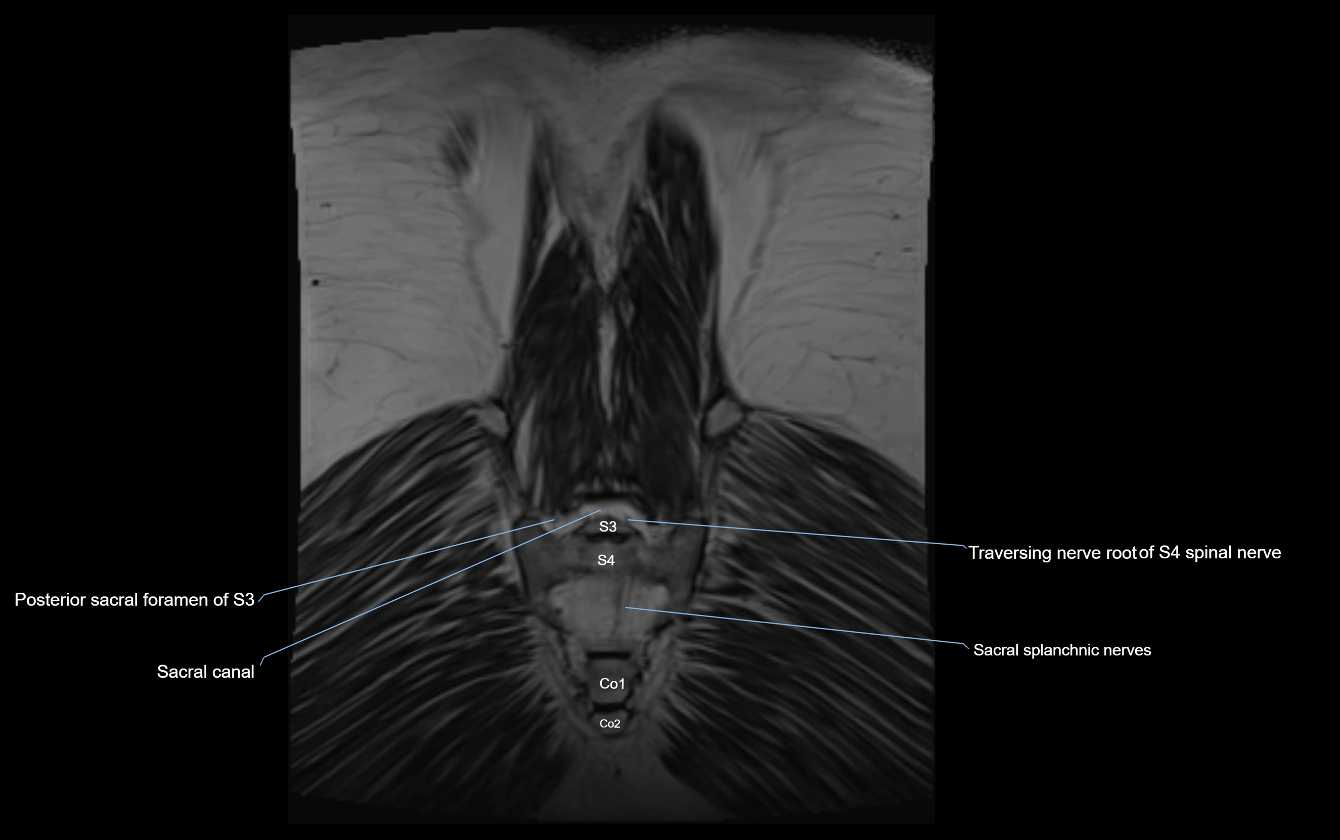 MR lumbosacral plexus cross sectional anatomy 3T  radiology  image-img-09001-00079.webp